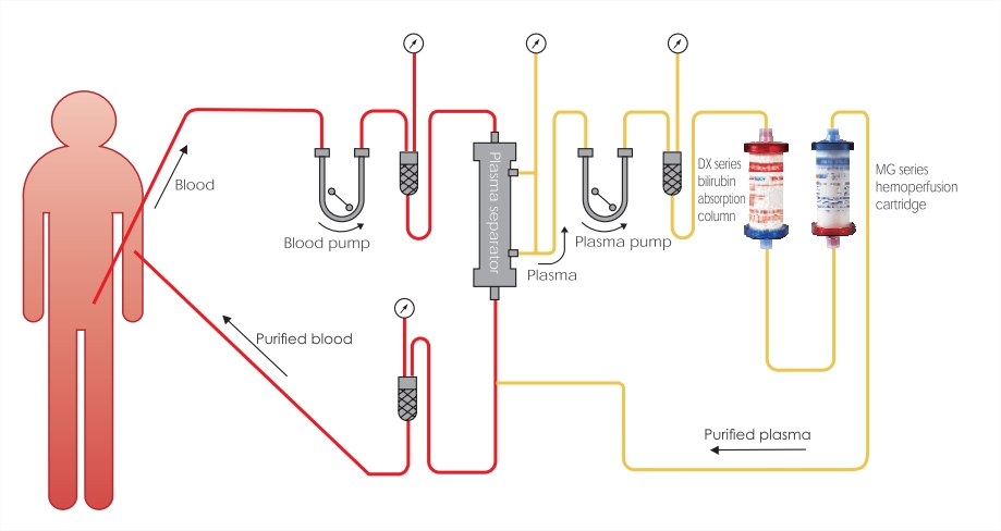 Double plasma molecule - Absorption system bilirubin absorption column