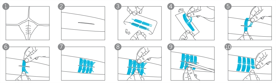 Wound closure device application