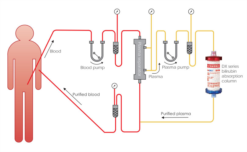 Treatment sketch - Plasma Bilirubin Absorption