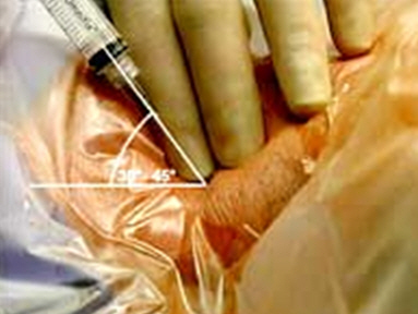 Angle direction of the needle - Hemodialysis catheter placement