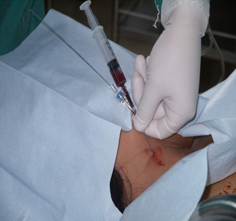 Insertion with Y-shaped syringe - Hemodialysis catheter placement